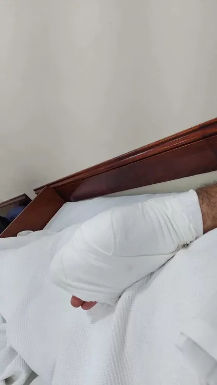 amputaron dedo