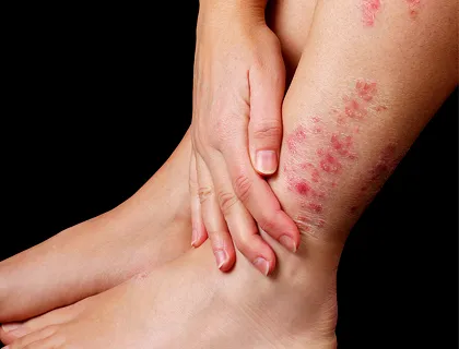 Culebrilla