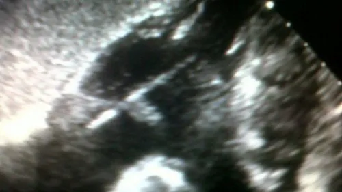 Escarbadientes-encontrado-medio-corazon_CLAIMA20151015_0107_39