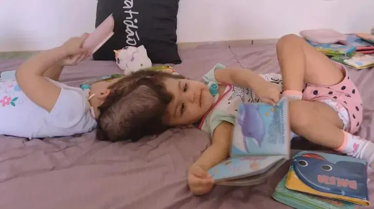 Allana y Mariah estaban unidas por el cráneo. (Foto: gentileza g1).