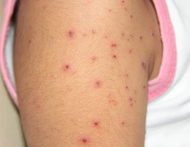 varicela
