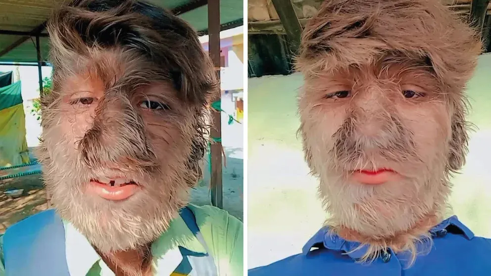 síndrome de lobo 2773