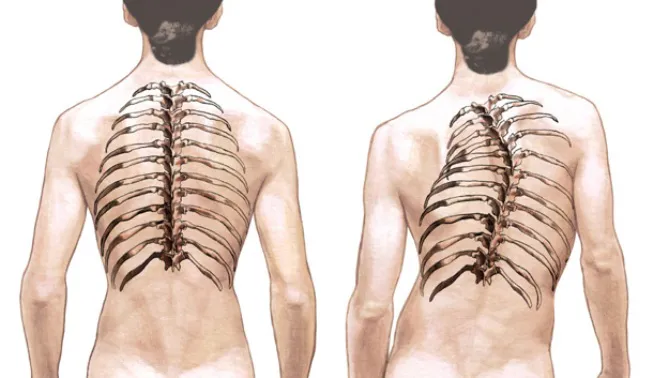 escoliosis