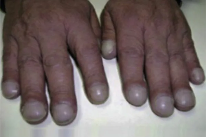 acropaquías