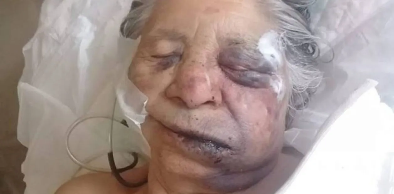 abuela desfigurada