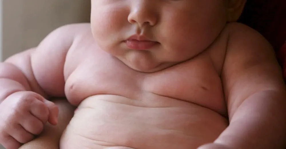 obesidad